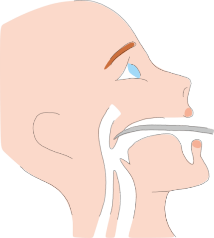 Radio frequency ablation surgery for snoring